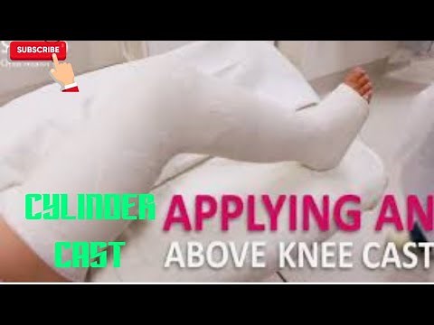 How to apply an cylinder cast Above Knee Cast pop
