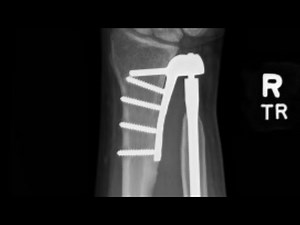 Aptis DRUJ wrist replacement 5 year update