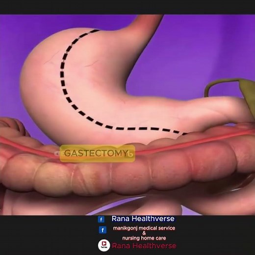 GASTRECTOMY Secrets Every Patient Needs to Know