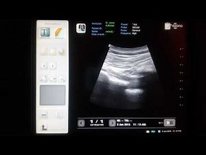 Ultrasound guided piriformis injection