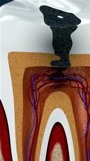Tooth Decay Stages Explained 🦷 | Prevent Cavities Early #dentist #toothdecay #dentalclinic #fyp