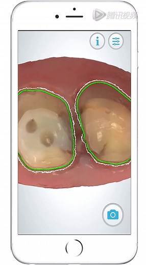 康泰健：3shape APP 应用简介