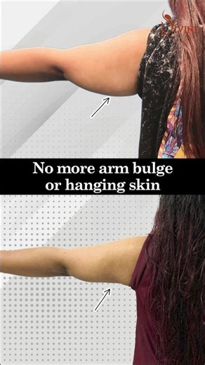 Short Scar Brachioplasty(Arm lift) Before and After | Best Arm Lift Suegeon in Delhi | #shortsfeed