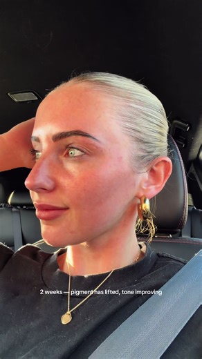 IPL for Uneven Skin Tone: 3-Week Transformation