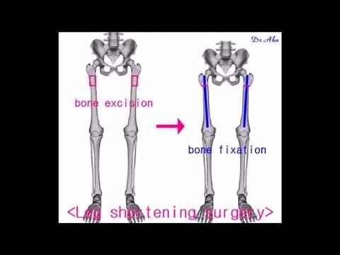 The principle of shortening the height (leg shortening surgery)