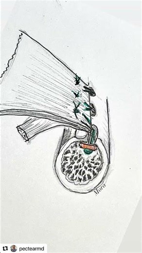 Here are some of my Pec FlexFix graft sketches I’m submit for the JBJS Technique submission.