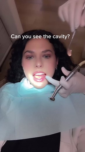 Big cavity on the back tooth is detected! Can you see it? #dentaltok #injection #dentist #gloves #injection
