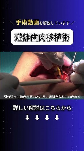 【閲覧注意】【外科治療】遊離歯肉移植術 #shorts