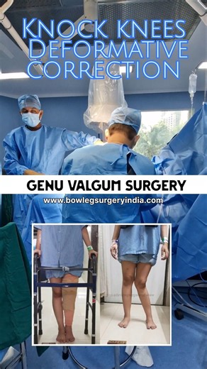 Open wedge knock knees surgery genu valgum deformative correction. #bowlegsurgeryindia #knockknees