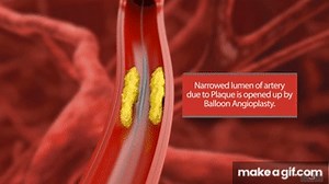 Angioplasty - Medical animation on Make a GIF