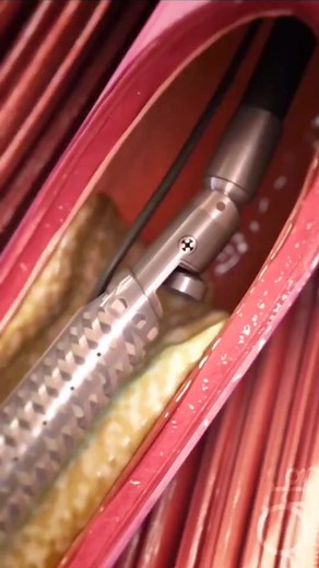 Directional Atherectomy 3D Animatiom #medical #doctor #medicaldevice #3danimation | T.Medical.V