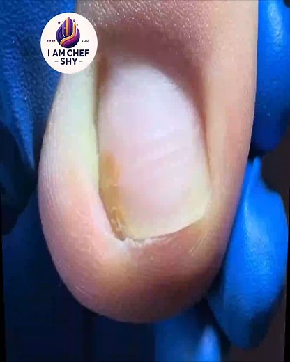 Safe Routines That Prevent Help Women in Wellness Programs Prevent Calluses and Cracks #SeniorHealth #DiabeticFootCare #WellnessSeniors #FootSupport | I am Chef Shy