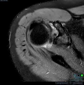 ADHESIVE CAPSULITIS (FROZEN SHOULDER) ON MRI