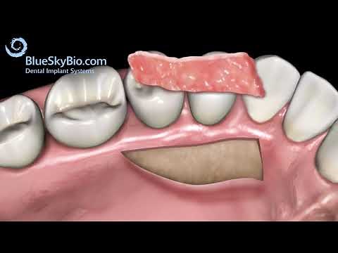 What is a gum-graft? Understanding Gum Graft Surgery: Advance Dental Implant and TMJ Center