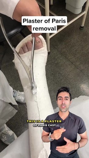 Plaster casts are used to keep broken bones stable while they heal. They harden quickly, hold their shape well, and offer strong support during recovery. When it’s time to come off, the cast is split with a vibrating saw, and the skin underneath is checked for any issues. VC: @willzera_asmr #medical #health #healthtips #fracture #castremoval | Kunal Sood, MD