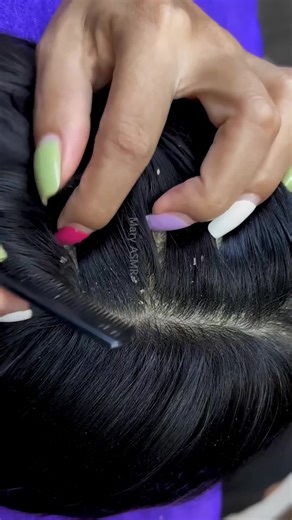Remove Itchy DRY Scalp Scratching Satisfying