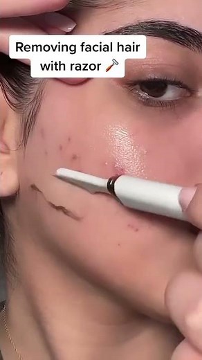 Cystic Acne Removal & Inflammatory Acne