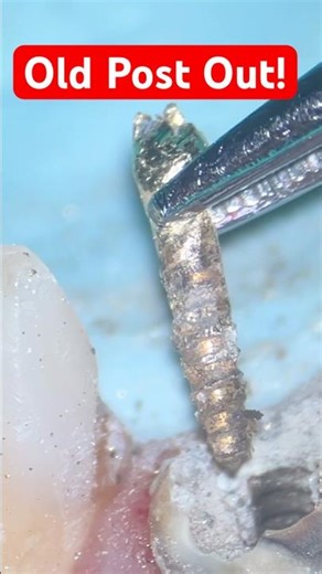 Unscrewing a 30-Year-Old Metal Post From Front Tooth!