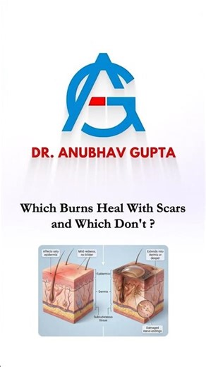 Burn Scars Explained | Which Burns Leave Scars & Which Heal Without Scars? #handsurgery