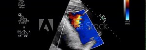 color echocardiogram of patient with AFIB
