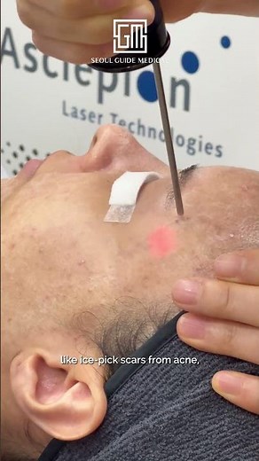 Scar-free beauty with the satisfying sound of Dermablate💆‍♀️