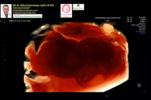 Understanding Hydrops Fetalis: Causes, Symptoms, and Management
