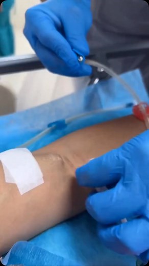 MedWorld- Medical & Health | An arteriovenous fistula is a surgically created connection between an artery and a vein, usually in the arm, allowing high blood flow... | Instagram