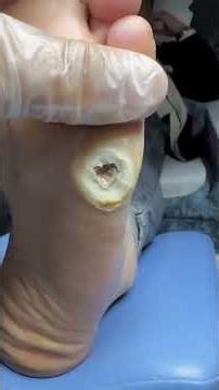 Ever wondered what a foot corn is and how to treat it? This video has all the answers you need!