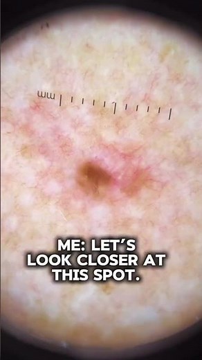 I get asked this often during skin cancer checks
