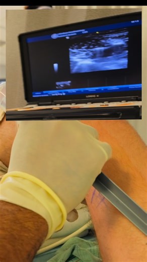 Naveed Tahir, MD on Instagram: "You need more volume for a sciatic nerve block #yourbestanesthesia #anesthesia #anesthesiology #anaesthesia #anaesthesiology #anesthesiologist #anaesthetist #anaesthesiologist #anesthesiaresidency #anesthesiaresident #crna #nurseanesthetist #nurseanesthesia #srna #caa #regionalanaesthesia #nerveblock #nerveblocks #nerveblockinjection #ultrasoundguided #ultrasoundguidedinjection"