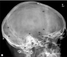 Cráneo, proyección lateral RX (parte 1)