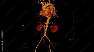 3D rendering image of CTA whole Abdominal Aorta generate from CT scanner.