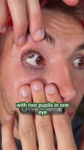 Strange Eye Disease 😏 Polycoria Explained! 🔥 #shorts #EyeFacts
