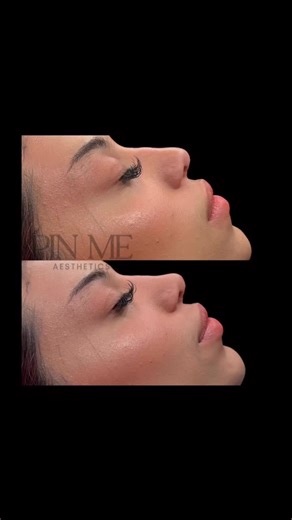 Transform Your Nose with a Pixie Nose Lift