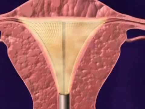 NovaSure Animation - Abnormal Uterine Bleeding