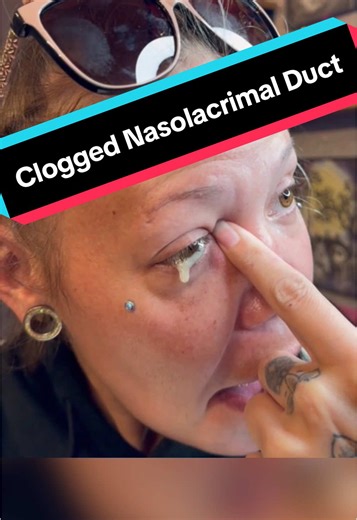 Clogged Nasolacrimal Duct: Symptoms and Treatments