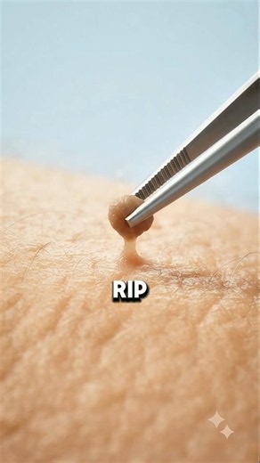 What Is a Skin Tag? 😨 | What's Inside It?