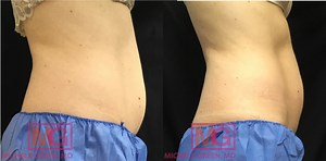 Kybella For Stomach Fat - Dr. Michele Green M.D. NYC