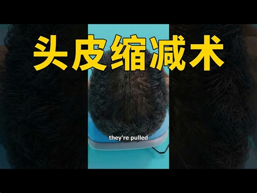 【中配】头皮缩减手术及其原理 - Zack D. Films