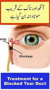 Treatment for a Blocked Tear Duct for Adults | Ansu ki nali band hona