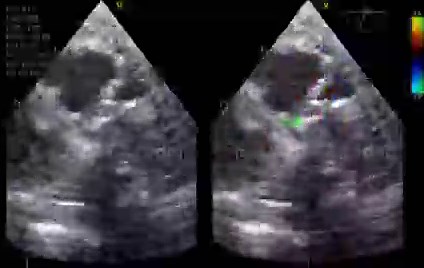 Normal post-procedural intraop TEE after arterial switch operation for (ASO) d-TGA/IVS #echofirst 📌 Beware of the surgically altered anatomy after ASO💙RA→RV→Neo PV (natAV)→PA❤️LA →LV →Neo AV (natPV)→Ao