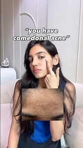 COMEDONAL ACNE ON FACE‼️ check description #acne #comedones #acnetips #acnetreatment #skindoctor