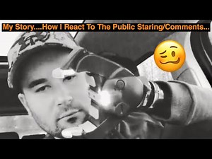 My Story| Amputee Dealing With The Public Staring/Asking About Amputation.