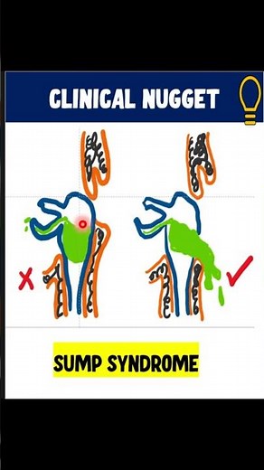 SUMP SYNDROME | DCR complication | #opthalmology #insightophthalmology