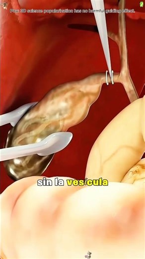 How Gallbladder Removal Surgery Is Done(3D Animation)#3dmedicalanimation #medical3danimation