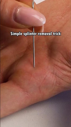 Simple Splinter Removal Trick Everyone Should Know! 🩹✨...