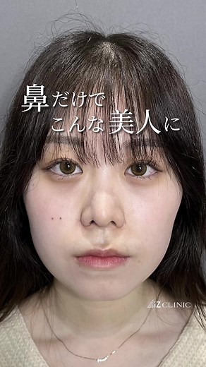 #鼻整形 #鼻中隔延長 #小鼻縮小 #プロテーゼ