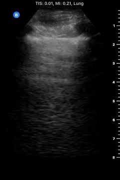 Lung Sliding Normal: Captured with Butterfly iQ™