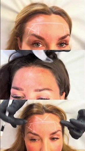 Botox Masterclass Online Course