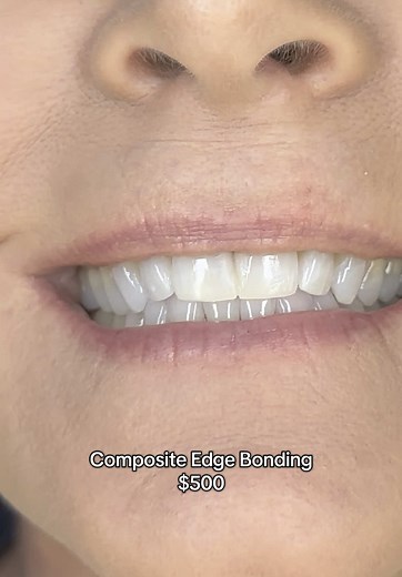 Composite Edge Bonding for Longer Front Teeth